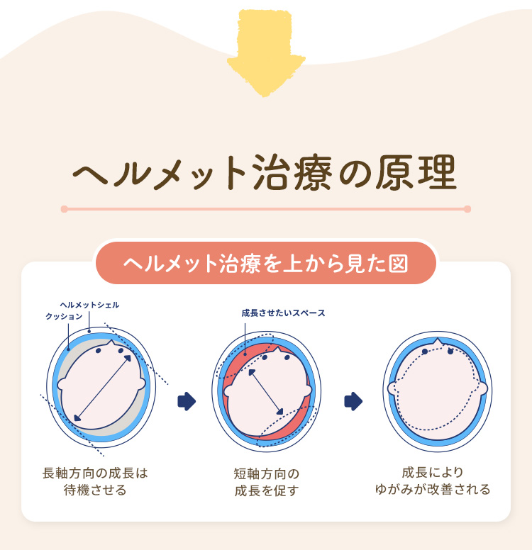 ヘルメット治療の原理