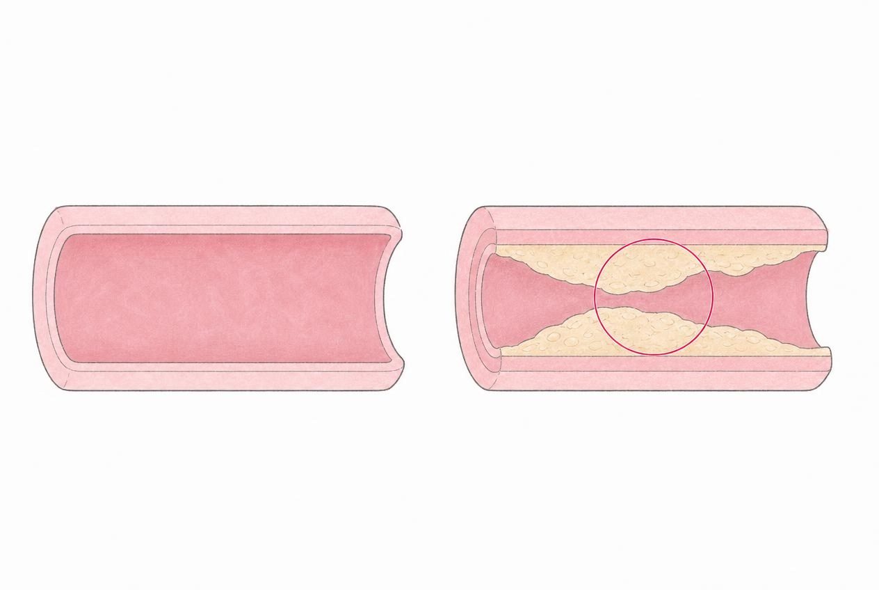 健康な血管と、壁が厚く硬くなりプラークで内側が狭くなった血管を並べた動脈硬化の図解