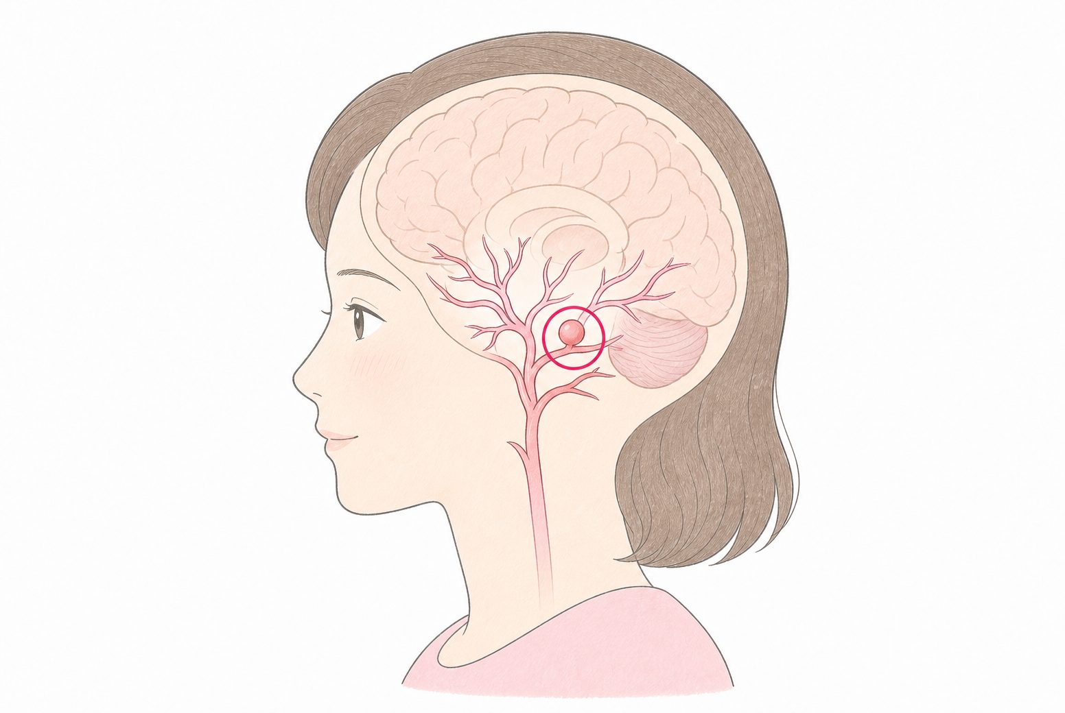 脳の血管の一部が風船のようにふくらんだ未破裂脳動脈瘤の図解